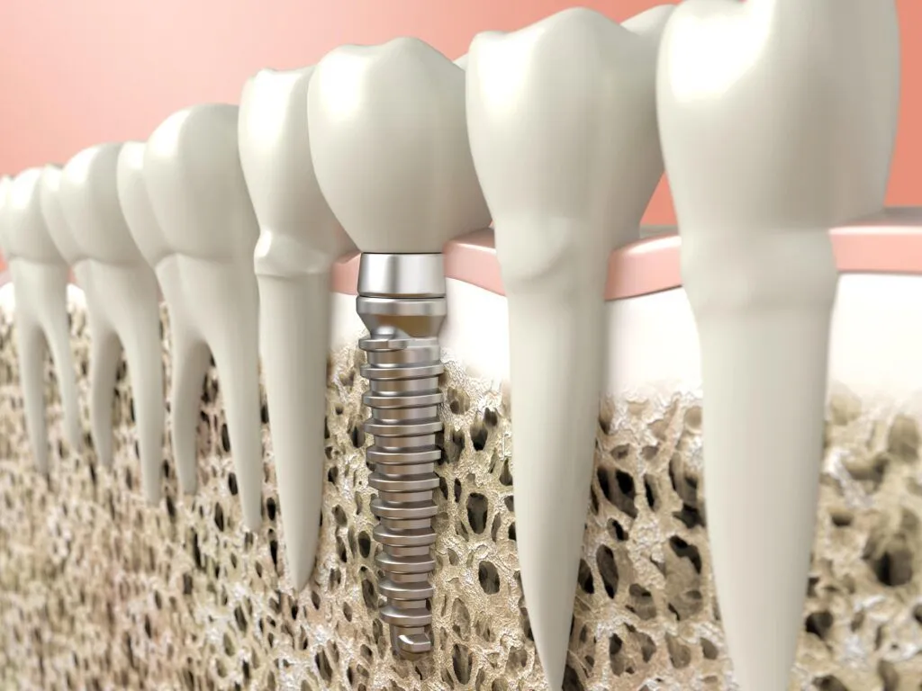 تاثیر ویتامین D بر ایمپلنت های دندانی