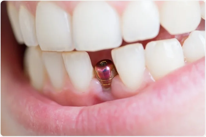 تاثیر داروها بر موفقیت ایمپلنت دندان